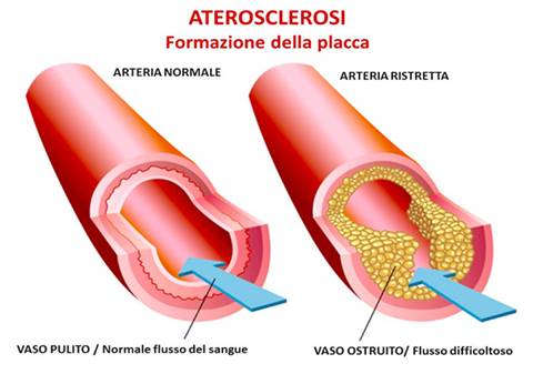 aterosclerosi