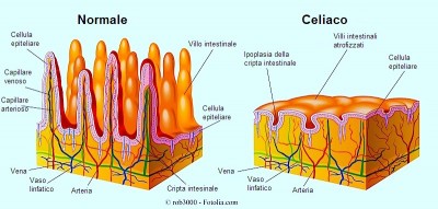 celiachia villi