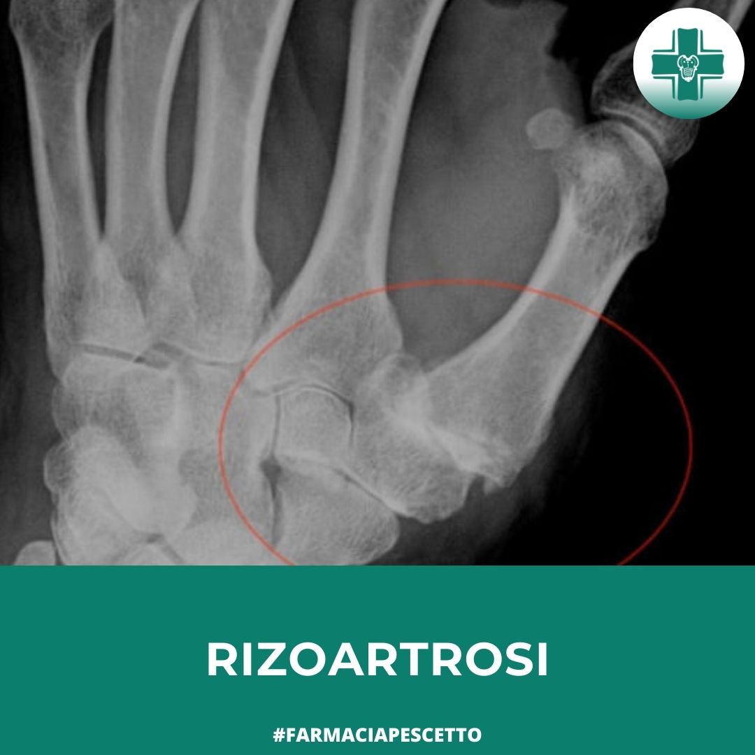 Rizoartrosi